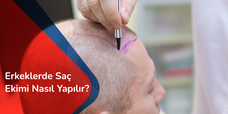 Erkeklerde Saç Ekimi Nasıl Yapılır?