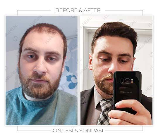 Hair Transplant Before and After