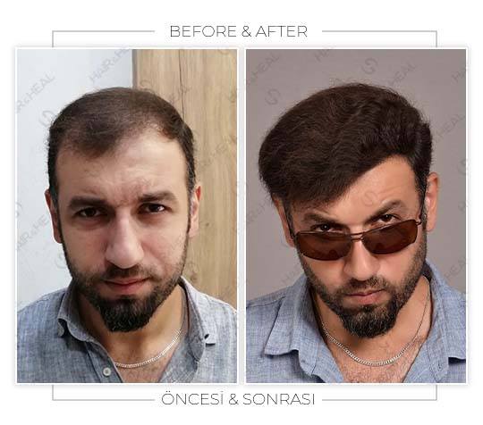 hair-transplant-before-after-06