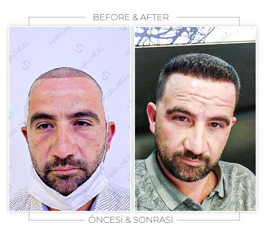 hair-transplant-before-after-07