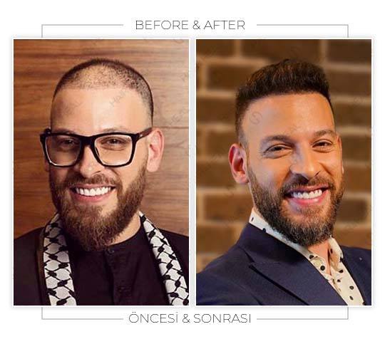 hair-transplant-before-after-08